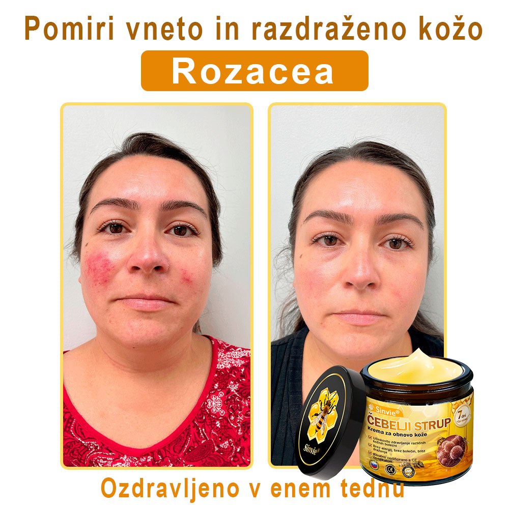 👨‍⚕Sinvie® Krema za obnovo kože z čebeljim strupom | 50 ml | Priporočeno dermatologov
