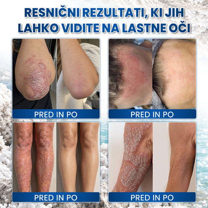 🌿Medistart® POSEBNA NEGA KOŽE PRI LUSKAVICI