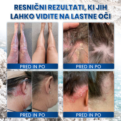 🌿Medistart® POSEBNA NEGA KOŽE PRI LUSKAVICI