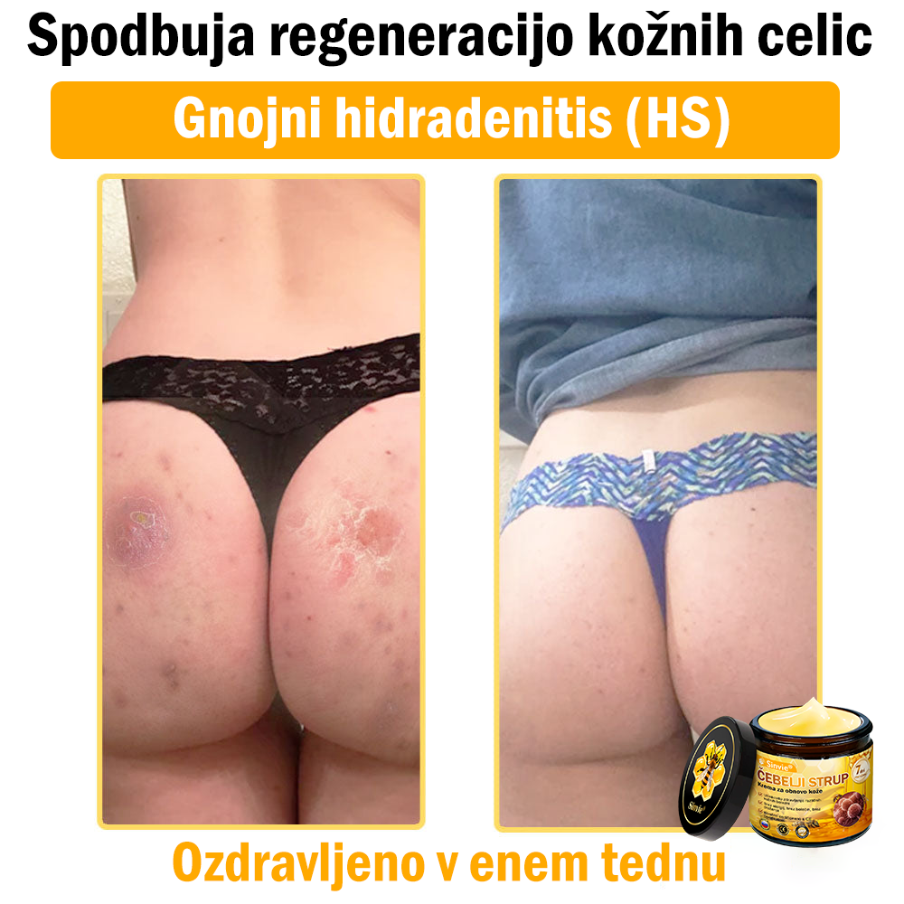 👨‍⚕Sinvie® Krema za obnovo kože z čebeljim strupom | 50 ml | Priporočeno dermatologov