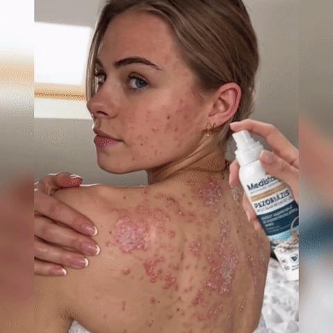 🌿Medistart® POSEBNA NEGA KOŽE PRI LUSKAVICI